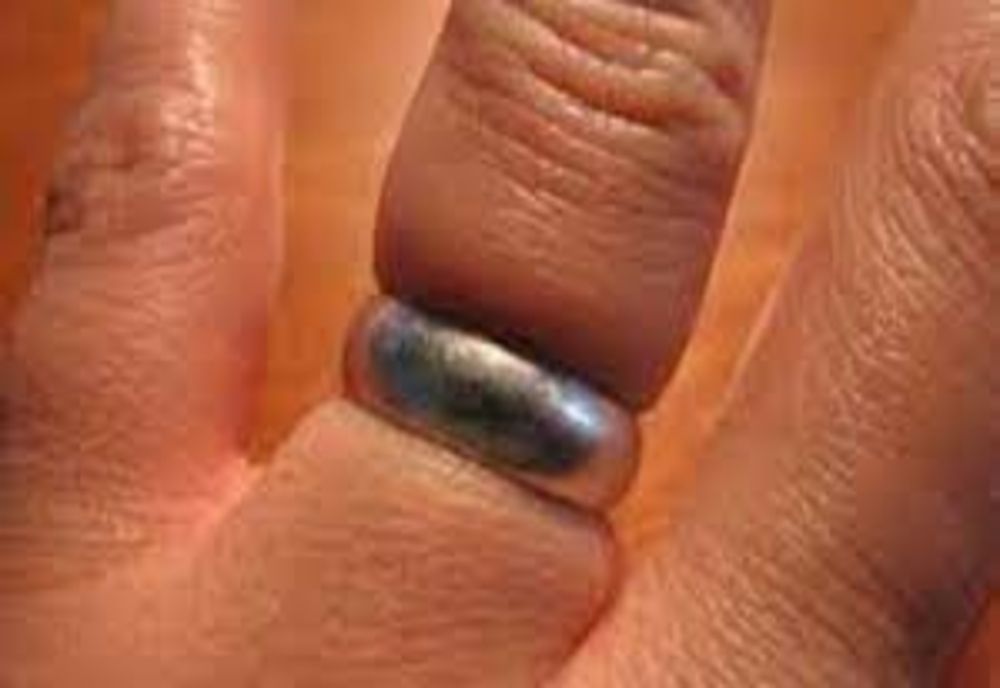 A ajuns la urgență din cauza unui inel