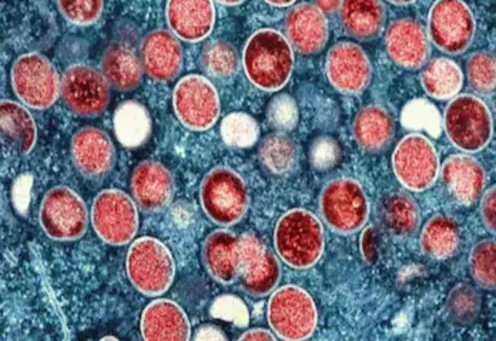 Alertă în Anglia: Un virus mortal face primele victime - Cine îl transmite - Simptomele encefalitei, asemănătoare gripei
