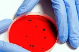 Suspiciune de antrax cutanat la Botoșani! Un bărbat de 44 de ani, internat la Boli Infecțioase