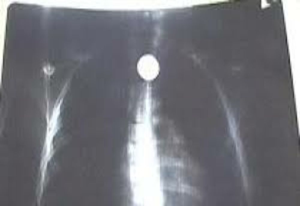 Un băiețel în vârstă de 3 ani a ajuns la spital după ce înghițit o monedă de 50 bani