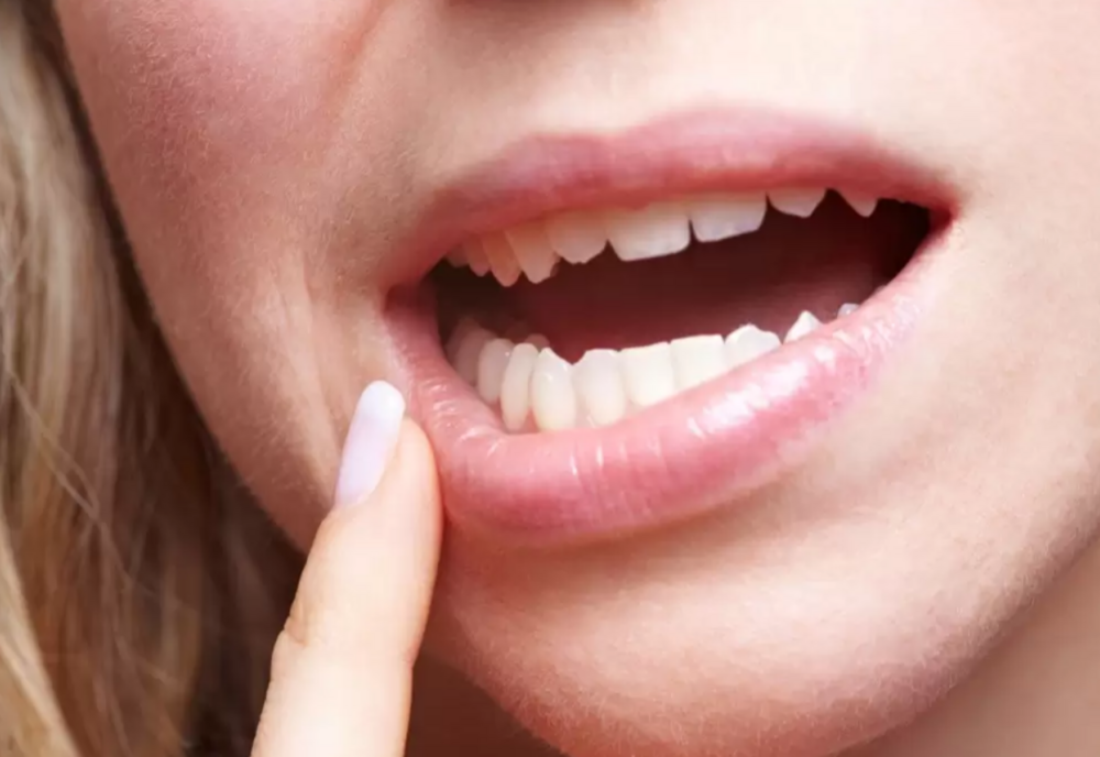 Aftele bucale. De ce apar și cum scăpăm de ele